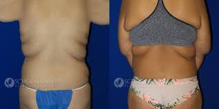 After Weight Loss Surgery In Encinitas Ca Dr Schoemann