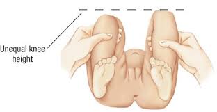 Image result for Galeazzi Sign