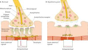 We discuss the pathophysiology, presentation, investigations. Myasthenia Gravis In De Tandheelkunde Ntvt