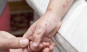 Check spelling or type a new query. Shingles In Children Chickenpox Shingles Children S Health