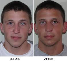 Nasal polyps aren't painful to the touch. Nasal Surgery Pictures New York Ny Sinus Surgeon