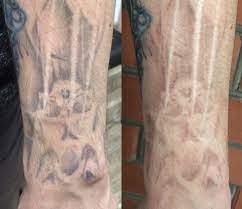 Home Based Tattoo Removal Without Laser Tattoo Removal Natural Tattoo Removal Diy Tattoo Permanent