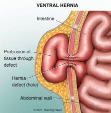 Laparoscopic hernia repair— the hernia is repaired by mesh or sutures inserted through instruments placed into small incisions in the abdomen. Incisional Hernia