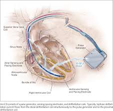 However, although the icd is highly effective at preventing sudden death, everyone will die eventually, whether of underlying heart disease or other terminal illness such as malignancy. Figure 1 From Evaluation And Management Of Patients After Implantable Cardioverter Defibrillator Shock Semantic Scholar