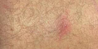 Exfoliation is a great way to get rid of ingrown hair and prevent its growth. How To Prevent Ingrown Hairs