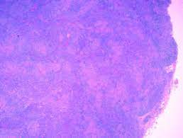 This lymphoma generally develops in the small intestine or colon. Angioimmunoblastic T Cell Lymphoma Dermnet Nz