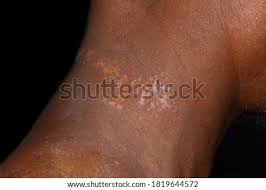 The name describes its appearance: Pityriasis Stock Photos Stock Images And Vectors Stockfresh