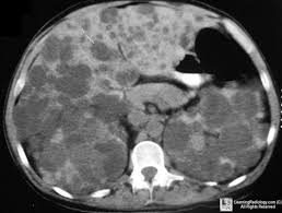 Polycystic Kidney Associated With Cysts In Liver 25 50 Pancreas 9 Aneurysm Polycystic Kidney Disease Polycystic Kidneys Radiology Imaging
