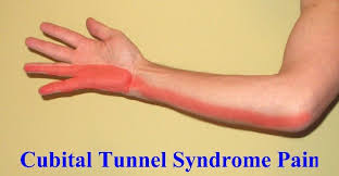 Hawkes Physiotherapy Blog Physio Based In Talke Stoke On Trent Staffordshire Physio Ac Cubital Tunnel Syndrome Carpal Tunnel Relief Carpal Tunnel Syndrome