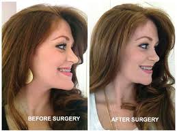 The First Phase Was A Procedure To Widen Her Upper Jaw And Further Expand It With An Orthodontic Appliance D Chin Reduction Surgery Jaw Surgery Chin Reduction