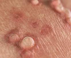 Image result for genital herpes