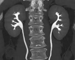 Image result for Helical CT Urogram