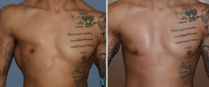 Treatment may require the coordinated efforts of a team of specialists. Plastic Surgery Case Study Custom Pectoral Implant In Male Poland Syndrome Explore Plastic Surgery