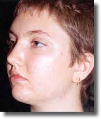 Before and After Pictures