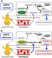 Image result for G6PD Deficiency Detection