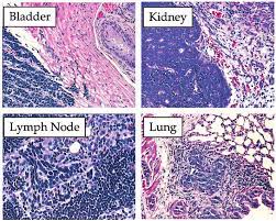 The result of your psa blood test. Histology Of Metastatic Prostate Cancers Prostate Tumors Were Obtained Download Scientific Diagram