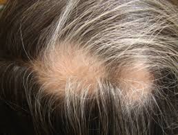 Vitiligo develops when cells called melanocytes die. Poliosis Dermnet Nz