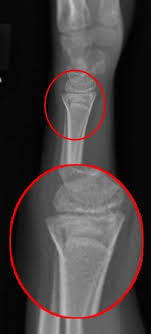 Maybe you would like to learn more about one of these? Torus Fracture Definition Causes Diagnosis Torus Fracture Treatment