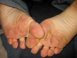 Nyeri Ibu Jari Kaki Tanda Asam Urat