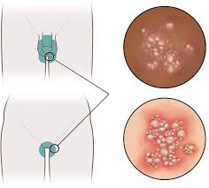 Image result for genital herpes