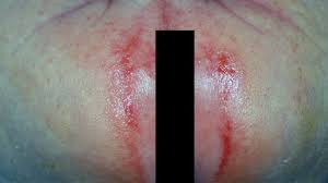 Image result for diaper dermatitis