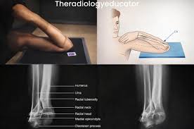 Image result for Elbow XRay