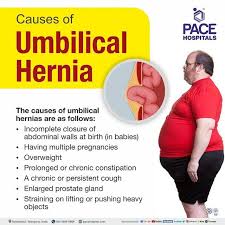 Image result for stomach hernia symptoms