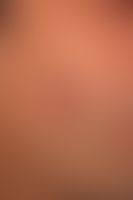 Its name comes from a distinctive pattern seen on a chest radiograph of many tiny spots distributed throughout the lung fields with the. Tuberculosis Cutis Luposa Altmeyers Enzyklopadie Fachbereich Dermatologie