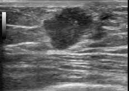 Ultrasounds and mammograms, though very helpful, are not perfect. Male Breast Cancer Radiology Reference Article Radiopaedia Org