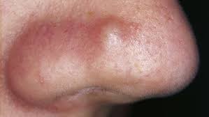 Image result for skin cancer on nose pimple