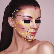 Scheme of the portals and the dissection area. Portal 1: eyebrow lift,...