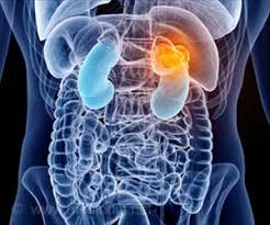 While the causes of kidney cancer in males are not wholly related to gender, men do, on average, have a higher chance of developing kidney cancer than women. Belly Fat Matters For Female But Not Male Kidney Cancer Patients
