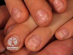 Image result for Beau lines feet