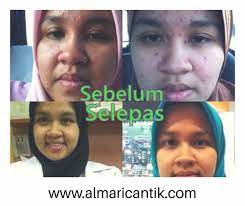 Parut ini jika tidak dirawat segera tidak akan pudar atau akan kekal dibadan atau wajah anda. Cara Hilangkan Parut Chicken Pox Yang Berlubang Dengan Cepat Almaricantik