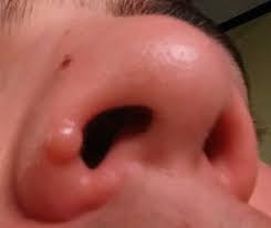 Stoppage of the nose from exposure to cold air. How Are Broken Noses Fixed Quora