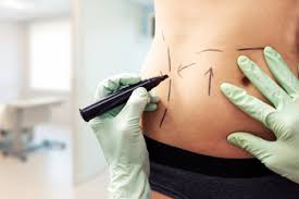 Image result for Liposuction
