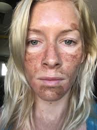 Das kann das chemische peeling. Pin Auf Tca Peel