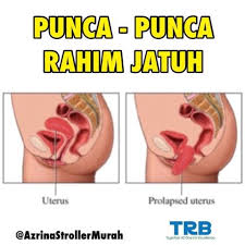 Anda ada masalah rahim jatuh atau tombong? Antara Punca Klinik Rumah Bersalin Lily Pasir Mas Facebook