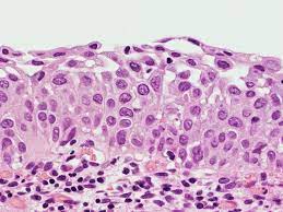 Maybe you would like to learn more about one of these? Pathology Outlines Squamous Metaplasia