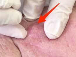 A small boil may burst and drain on its own without any assistance. Dr Zit Zapper Squeezes Out Explosive Cheek Abscess Insider