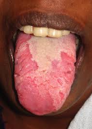 Geographic Tongue Symptoms Causes Treatment Prevention