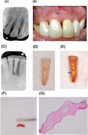 Early diagnosis and appropriate treatment will avoid unnecessary tooth extraction and result in a better prognosis. Cemental Tear To Know What We Have Neglected In Dental Practice Sciencedirect