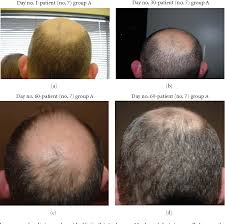 The incidence of this condition is the same for men as it is for women. Pdf Pilot Study Of 15 Patients Receiving A New Treatment Regimen For Androgenic Alopecia The Effects Of Atopy On Aga Semantic Scholar