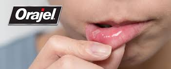 Its generic name is miconazole nitrate (oral gel). Philadelphia Orajel Baby Orajel Drug Injury Lawyers 215 546 2604 Feldman Pinto
