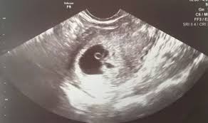 We are overjoyed and relieved! What Should An Ultrasound Show At 6 Weeks And 4 Days Of Pregnancy Quora