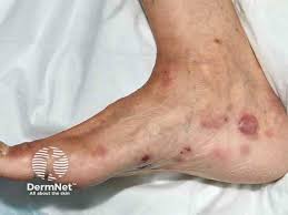 Image result for Pemphigoid