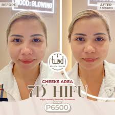 Having excess 𝐰𝐞𝐢𝐠𝐡𝐭 𝐚𝐧𝐝 𝐩𝐮𝐟𝐟𝐢𝐧𝐞𝐬𝐬 in your cheeks can be  frustrating. Although it's not possible to lose weight in just one part of  your body. But with The White Drip, you can