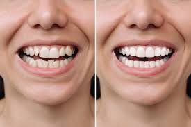 Dental Veneers in Brampton