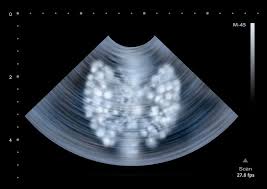 What does throat cancer look like? Tool Aids In Selecting Patients With Papillary Microcarcinoma For Active Surveillance