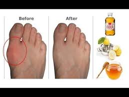 Pin On You Must Know This Side Effects Of Apple Cider Vinegar